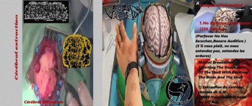 Mental Breakdown Affecting The Ossification Of The Skull With Bursting The Brain And The Skull : Cérébral Extraction